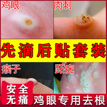 (Corns plaster set) Baiyun Mountain to the corns special plantar hand and foot treatment Yunnan stare care solution