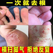 Beriberi ointment root root root removal artifact to fungus blisters anti-itching cream feet itchy feet hands and feet peeling dry and deodorant