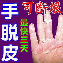 Hand peeling seasonal repair cream Palm fingers molting