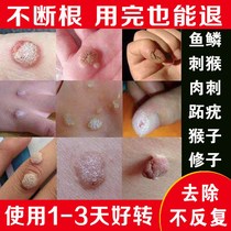 Wart removal net thorn monkey Removal of monkey medicine meat pellets adenocarcinoma Repair medicine Hand and foot scale mole cream