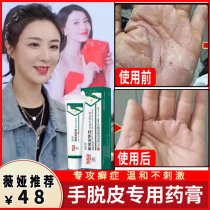 Hand peeling ointment hand moss hand itching what kind of sweat blister medicine hand long blisters infection itching and sterilization