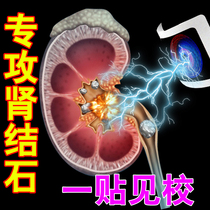 Kidney-removed gallstones (recommended by physicians) Chinese herbal medicine patch non-vibration therapeutic device stone Buster
