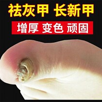 Shujia potassium An kit Nail fungus antibacterial whale Wang gray nail liquid Beijing official website flagship store A Yikang Nius