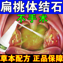 Tonsil stone removal tool cleaning throat foreign body sensation halitosis stone tonsil inflammation hypertrophy swelling medicine