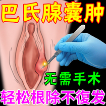 Pap gland vestibular large gland cyst secretion abnormal vulvar itching pain falling swelling feeling potassium permanganate private lotion