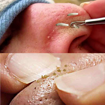 (Dont squeeze me to suck) Let the pores drain the dirty stuff like a puff and go to 99% facial pores litter
