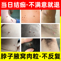 Medicine for monkey meat pellets Pimple Neck epithelial fat Special small meat thorn scorpion Scale mole removal artifact