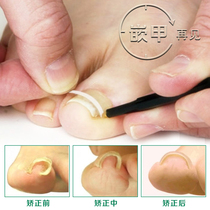 Life vertical embedded nail corrector Toenail orthopedic toenail correction Roll nail correction patch Positive nail patch Nail groove