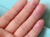 22 hands up with small blisters Blisters Bitchy dry cleft Dry Cracked Hand Cream Hand Peeling Seasonal Hand Peeling Repair Cream