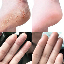 Peeling hands and feet Seasonal finger cracking Dry crack Dry crack Rough crack Crack-proof crack Ancient extract healing cream