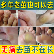 Remove calluses cocoon removal cream thick cocoon on the soles of the feet callus foot pad medicine hand joint cocoon dead skin softener artifact