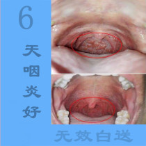 Pharyngitis spray chronic pharyngitis vocal cord polyp follicular hyperplasia foreign body sensation cough and phlegm propolis atomizing spray