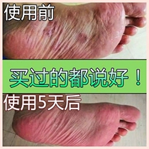 Beriberi Shen oil Shanghai Zhous Beriberi cream Foot stink foot treasure itchy foot blisters foot cream