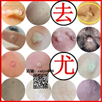 Drug treatment Prick removal cream painless removal of flesh thorn Monkey prick prick plantar wart Prick Prick Prick Prick Prick Prick Prick Prick Prick Prick Prick Prick Prick