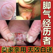 Beriberi cream anti-itch root artifact Anti-fungal blisters Anti-itch cream itchy feet rotten feet peeling hands and feet chapped feet cream