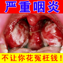 Throat phlegm Foreign body sensation Tonsils inflammation hypertrophy swelling throat swelling pain throat dry itchy cough follicles stop itching
