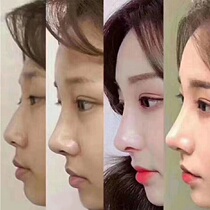 Japan imported American nose artifact thin nose narrowing nose orthosis