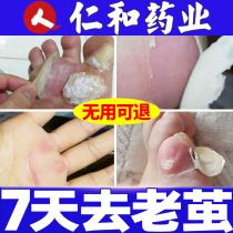 Clear cocoon removal of calluses foot Cocoon softener removal of foot hard skin calluses dead skin foot pad paste special artifact medicine