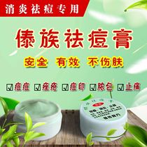 Dai acne cream to tease the mark to remove blackhead acne pain relief anti-swelling ointment to repair acne allergic skin