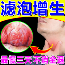 Follicular hyperplasia chronic pharyngitis patch treatment of lymphopharyngeal Wall tongue root foreign body sensation in the eradication of tea medicine artifact