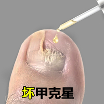 (Small Red Book Recommendation) Grey Potassium Net Finger Toenails Repair Special Inflammation Detumescence Decemal Cream Bacteriostatic Liquid