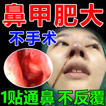 Special agent for anti-inflammatory repair of nasal mucosa of nasal turbinate hypertrophy; radical cure of nasal polyps; nasal obstruction; nasal drying