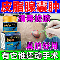 Sebaceous cyst cream powder tumor extraction cream treatment subcutaneous cyst hard lump acne pustules clogging removal artifact