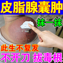 Sebaceous gland cyst lipoma removal artifact anti-tumor cream eliminates redness and nodule hard block acne fire furuncle pulling poison cream