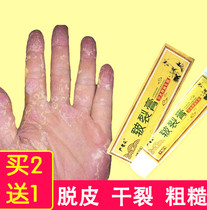 Hand peeling repair cream Fingers burst skin peeling dry palms Fade skin Peeling Dry chapped hands molt seasonal