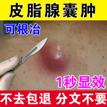 Sebaceous gland cyst cream anti-paring powder tumor patch removes subcutaneous cyst extraction cream treatment cyst acne artifact
