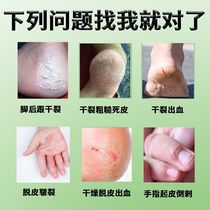 3 Boxed hand peeling Finger tip violent skin summer hand palm cracking Faded skin medicine Hand peeling dry and rich