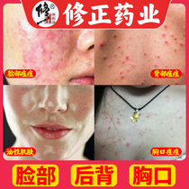 Fix mite soap back acne Shanghai sulfur soap to remove mites back acne front chest mouth back acne