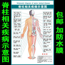  Schematic diagram of human spine-related diseases Traditional Chinese medicine health spine pathological causes Structure diagram Wall chart poster wall painting