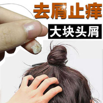 Dandruff itching oil control shampoo desite remove mites treat large dandruff artifact serious medicine for men and women